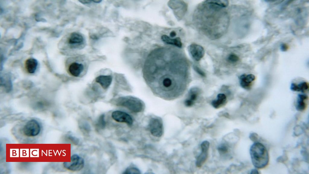 Gehirnfressende Amöbe: Warnung in Florida nach seltenem Infektionsfall