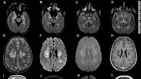 Gehirnscans aus der am 8. Juli veröffentlichten Studie des University College London.
